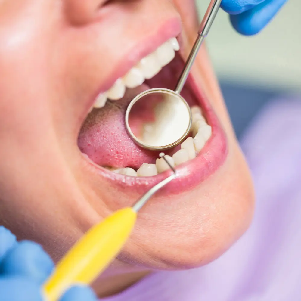 Patient getting their teeth checked for potential fillings